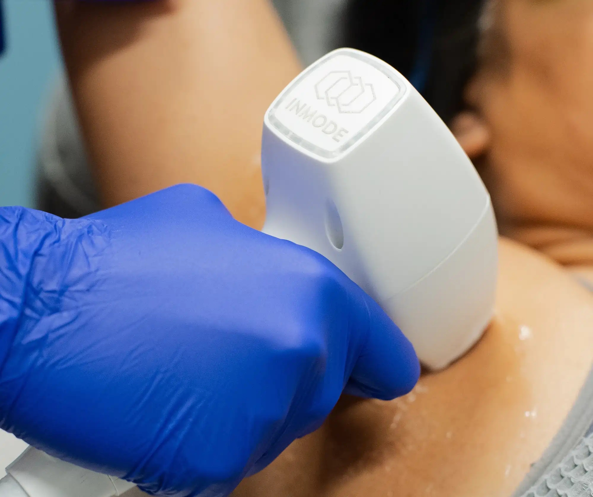 Laser Hair removal | Nona Medspa in Orlando, FL