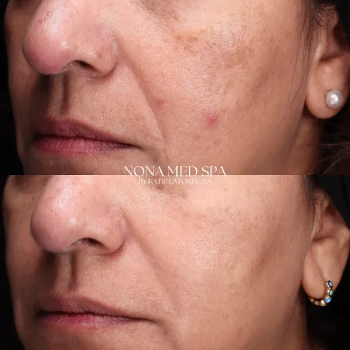 Skin improvement results | Orlando FL aesthetics clinic