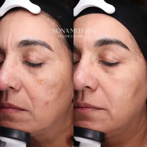 Before and after photos of facial treatments in Orlando, Florida
