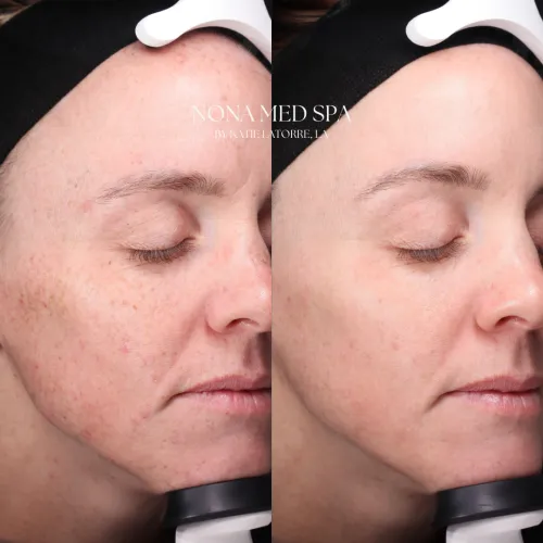 BBL cool peel | Nona Medspa in Orlando, FL