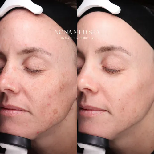 BBL cool peel | Nona Medspa in Orlando, FL