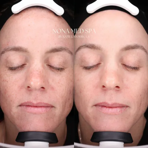 BBL | Nona Medspa in Orlando, FL
