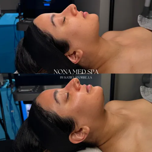 Hydrafacial Treatment by Nona Medspa in Orlando FL