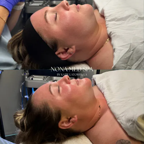 Hydrafacial | Before and After Images in Orlando FL