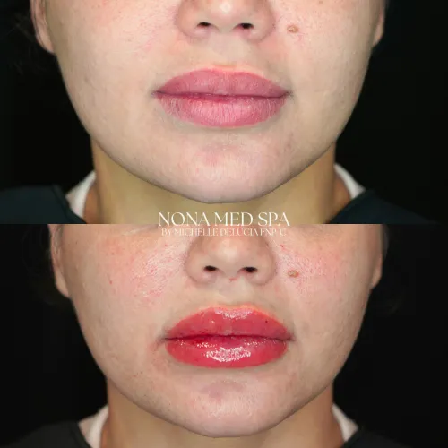 Lip Fillers | Before and After Images in Orlando FL