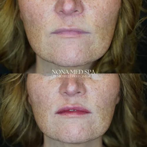 Lip Fillers | Nona Medspa in Orlando, FL