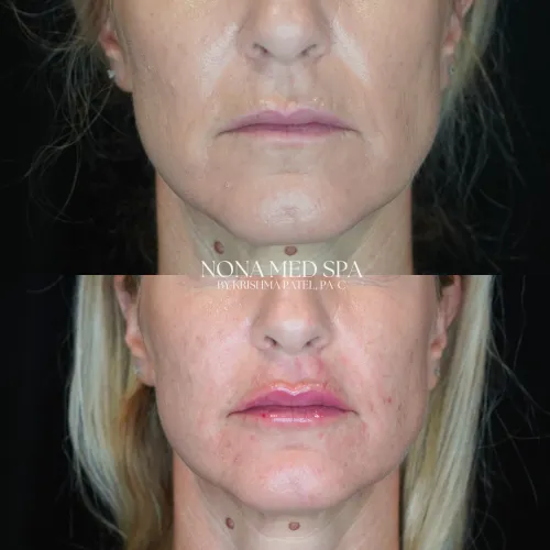 Lip Fillers | Nona Medspa in Orlando, FL