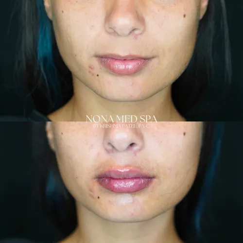 Lip Fillers | Nona Medspa in Orlando, FL