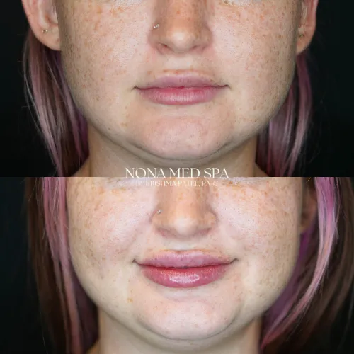 Lip Fillers | Nona Medspa in Orlando, FL