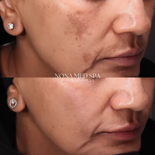 Microneedling, Hydroquinone, and Picosure Treatment Plan