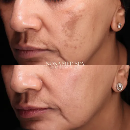 Microneedling, Hydroquinone, and Picosure Treatment Plan