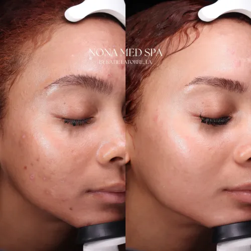 Moxi Treatments | Before and After Gallery in Orlando FL