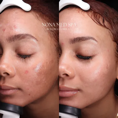 Moxi Treatments | Before and After Gallery in Orlando FL