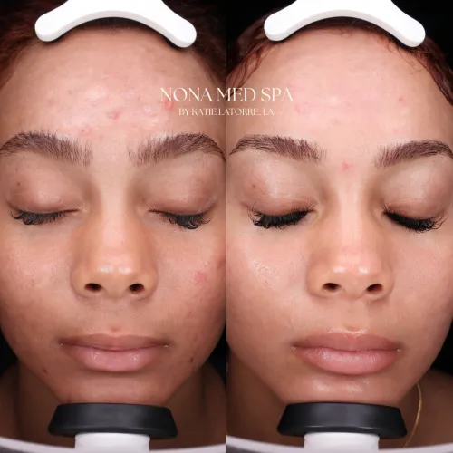 Moxi Treatments | Before and After Gallery in Orlando FL