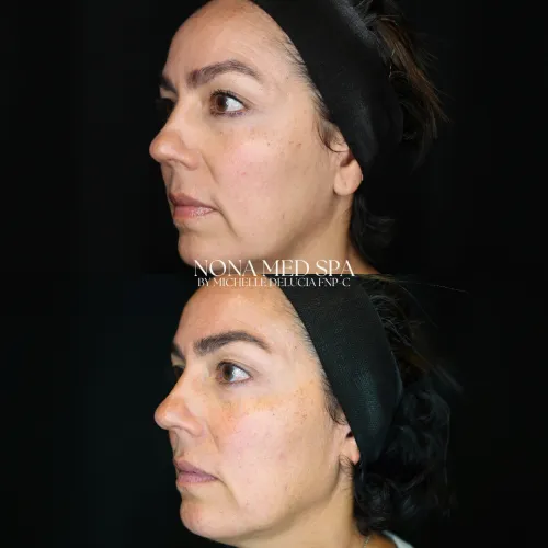 Facial rebalancing | Before and After Images in Orlando FL