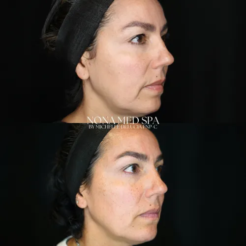 Facial rebalancing | Before and After Images in Orlando FL