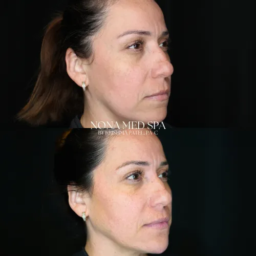 Facial rebalancing | Before and After Images in Orlando FL