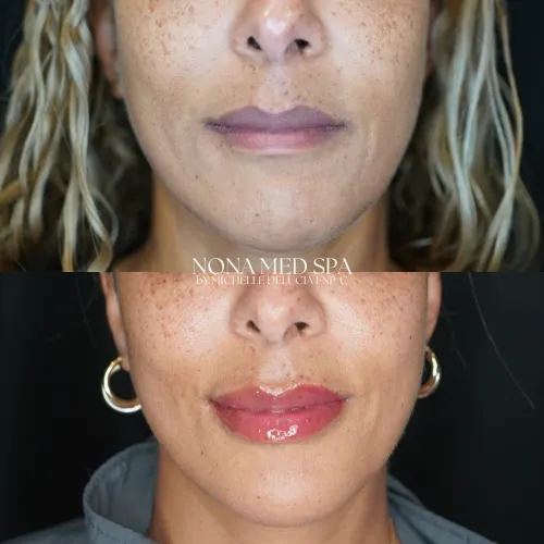Lip Fillers | Nona Medspa in Orlando, FL
