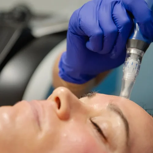 microneedling-b-at-nona-med-spa-in-orlando-fl