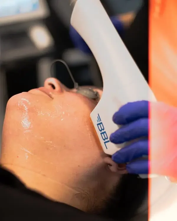 Benefits of BBL Treatment in Orlando FL